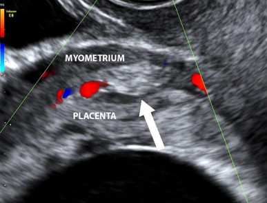 Placenta Accreta Ultrasound Findings