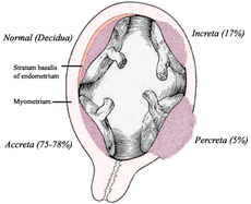 Placenta Accreta Ultrasound Findings