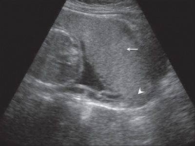 Placenta Accreta Ultrasound Findings