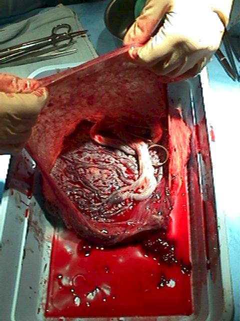 Placenta After Birth