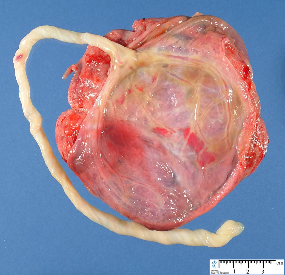 Placenta And Umbilical Cord