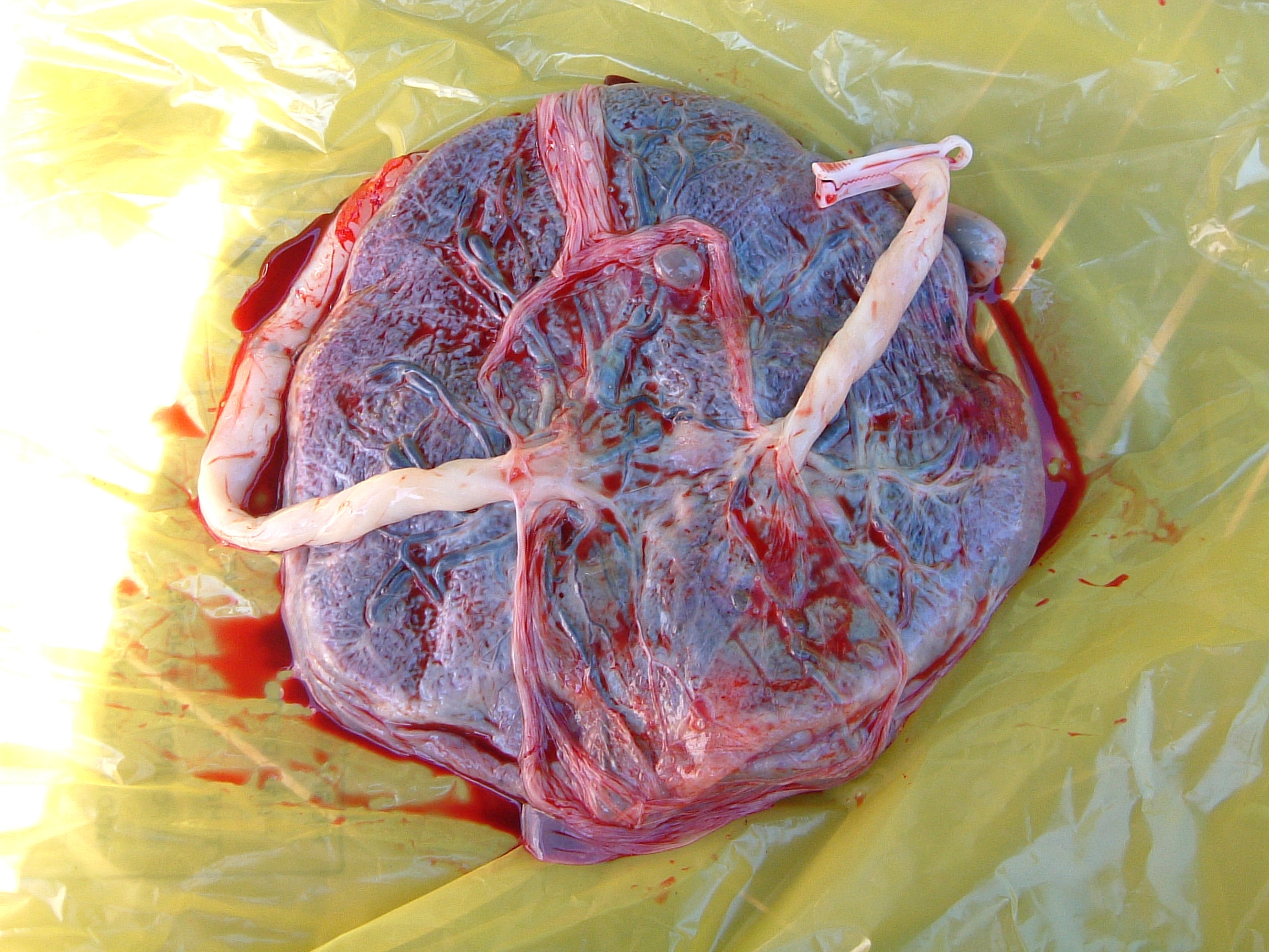 Placenta And Umbilical Cord