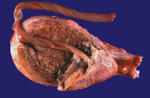 Placenta Praevia