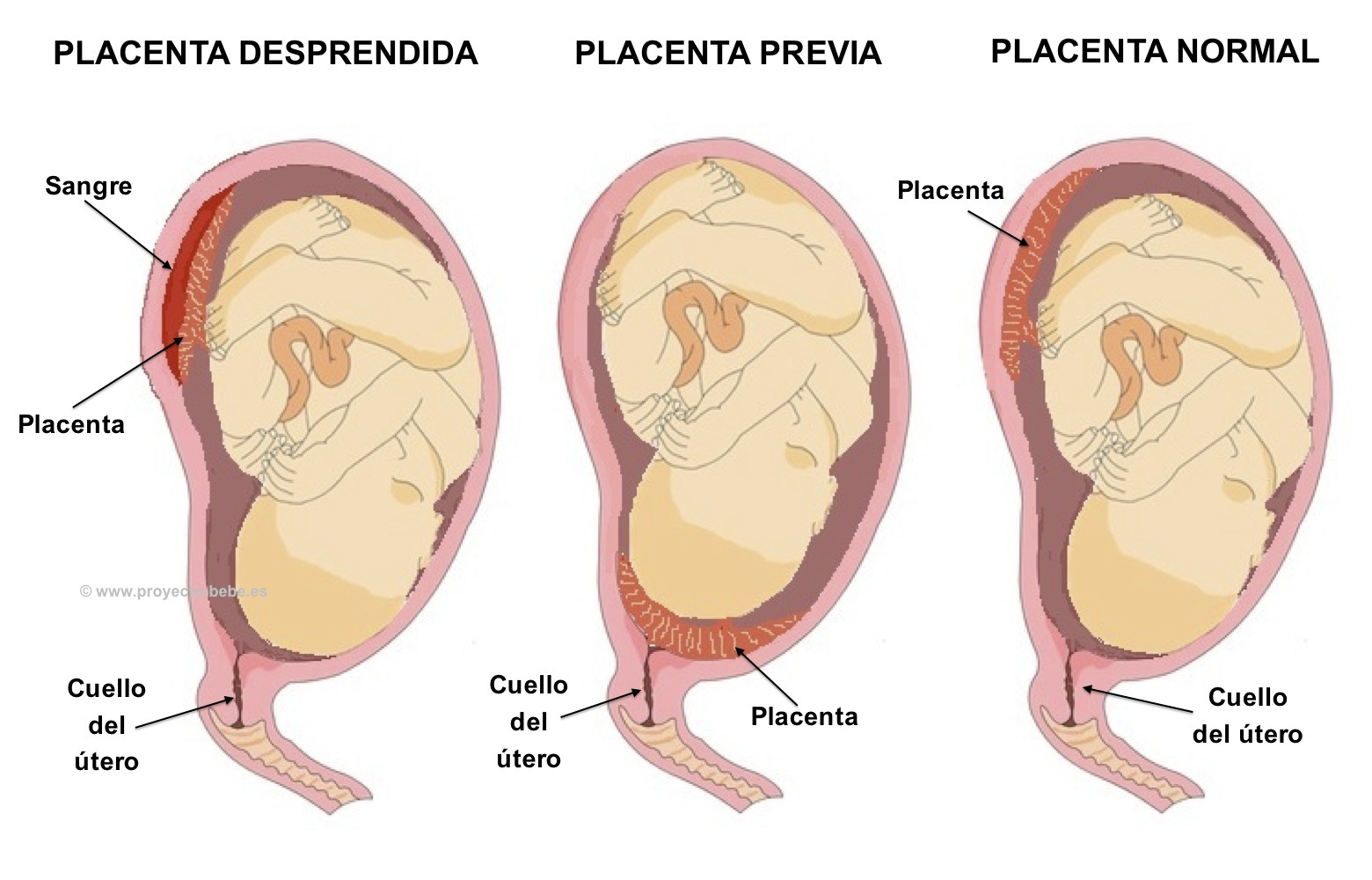 Placenta Previa