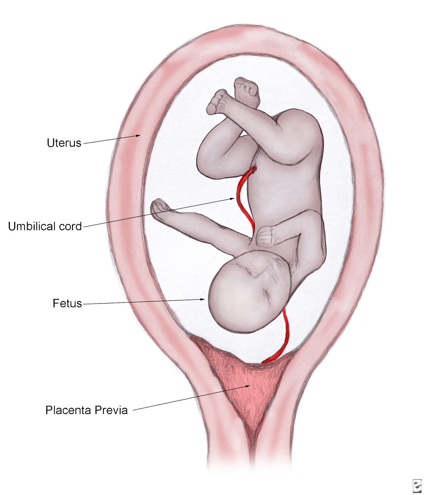 Placenta Previa