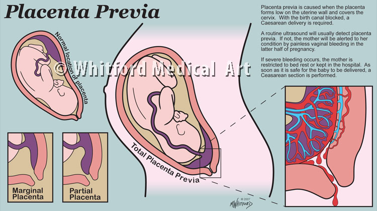 Placenta Previa