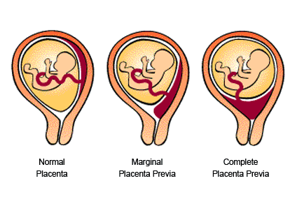 Placenta Previa Grade 3