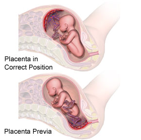 Placenta Previa Grade 3