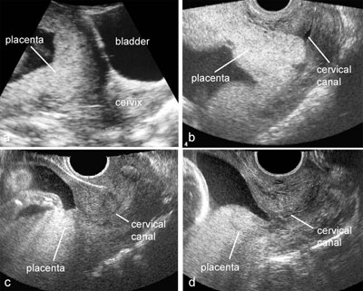 Placenta Previa Grade 3