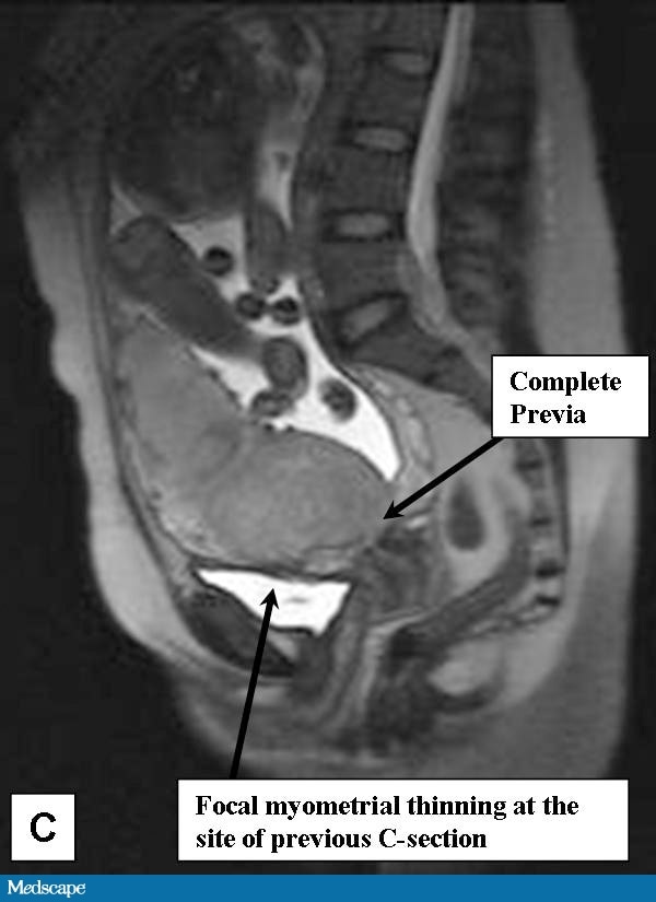 Placenta Previa Grade 3