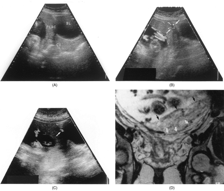 Placenta Previa Marginal Pdf