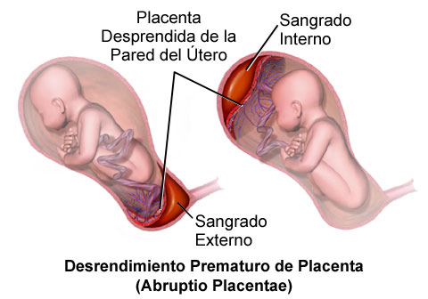 Placenta Previa Marginal Pdf