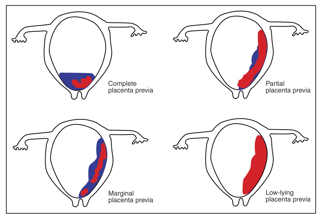 Placenta Previa Marginal Pdf