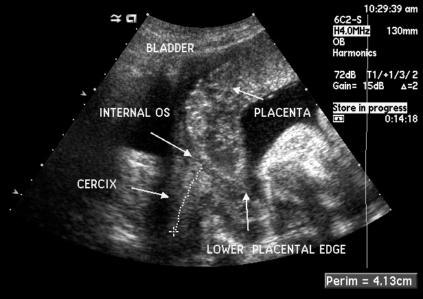 Placenta Previa Marginal Pdf