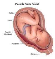 Placenta Previa Marginal Pdf