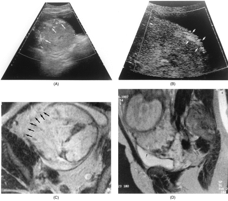 Placenta Previa Marginal Pdf