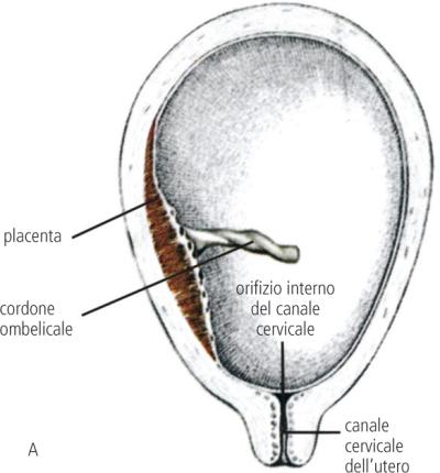 Placenta Previa Marginale