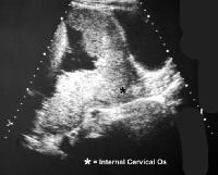 Placenta Previa Ultrasound Findings