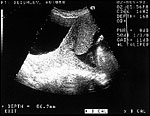 Placenta Previa Ultrasound Findings