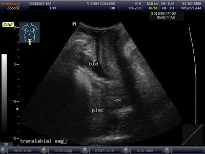 Placenta Previa Ultrasound Findings