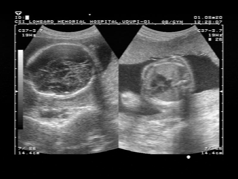 Placenta Previa Ultrasound Findings