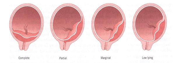 Placenta Previa Ultrasound Findings