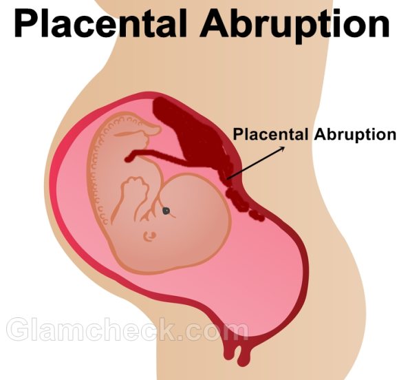 Placental Abruption