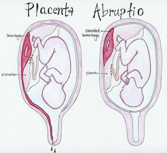 Placental Abruption