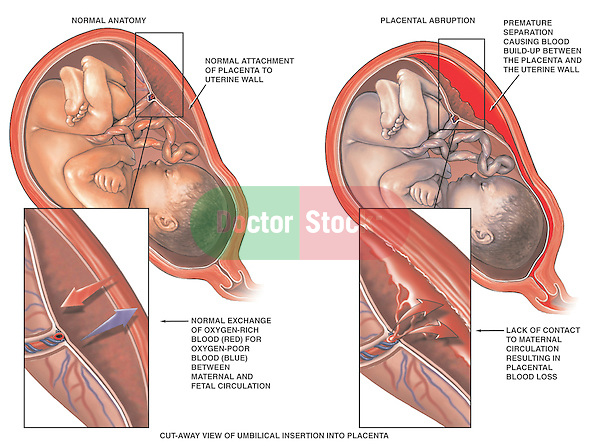 Placental Abruption