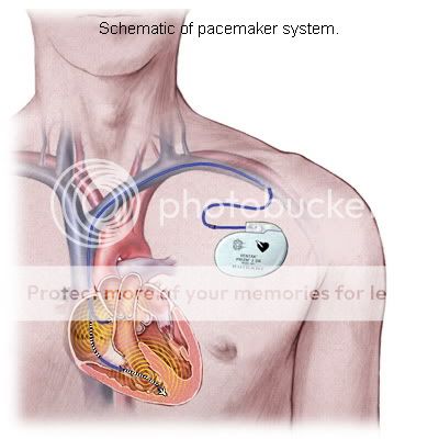 Plutonium Battery Pacemaker