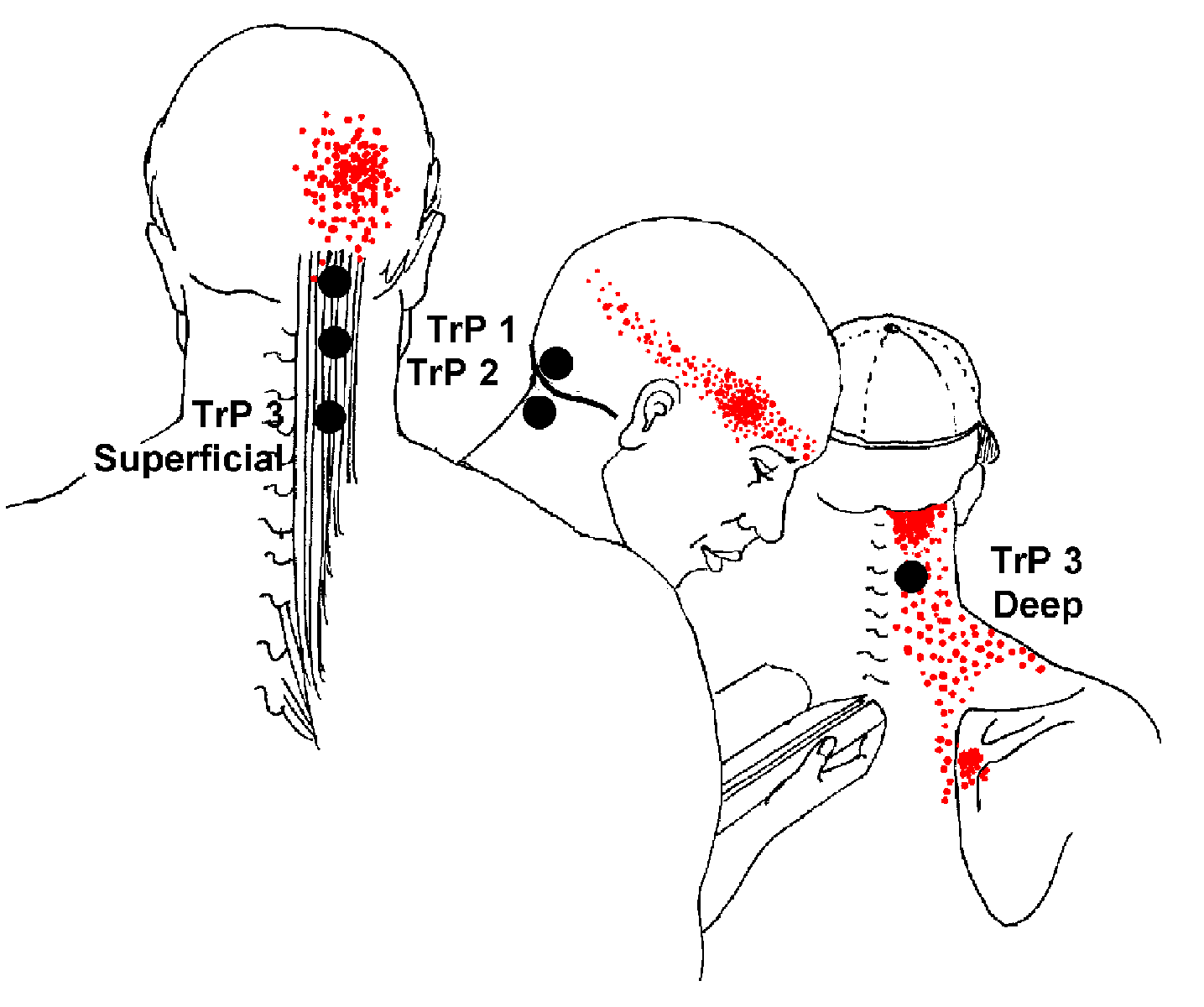 Pressure Points On Head Hurt