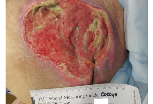 Pressure Sores Grading Scale