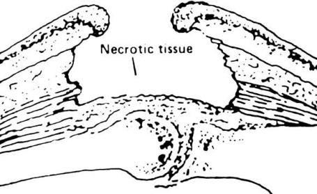 Pressure Sores Grading Scale