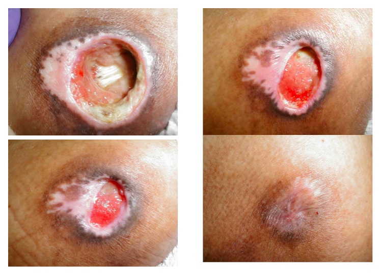 Pressure Sores Pictures