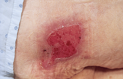 Pressure Sores Pictures Of Stages