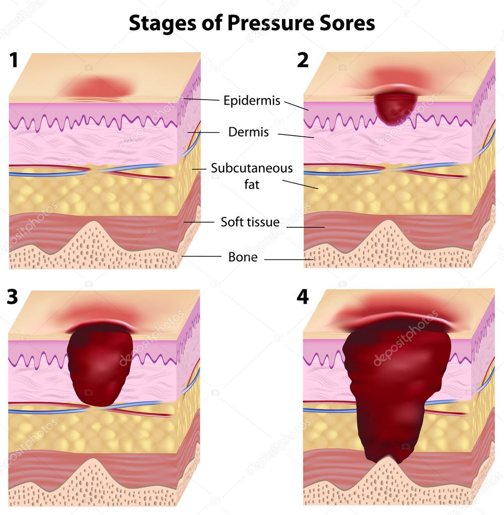 Pressure Sores Pictures Of Stages