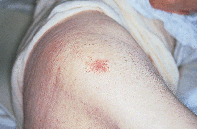 Pressure Sores Stage 1