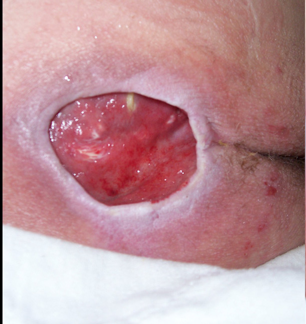 Pressure Sores Stage 1