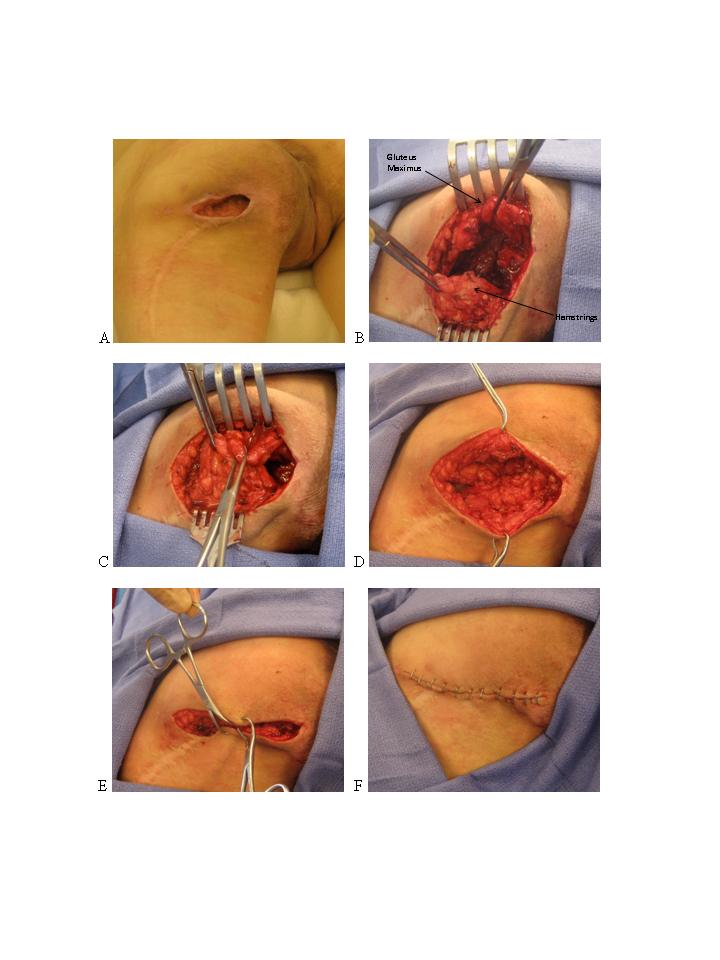 Pressure Sores Stages