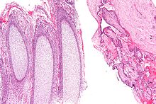 Products Of Conception Histology