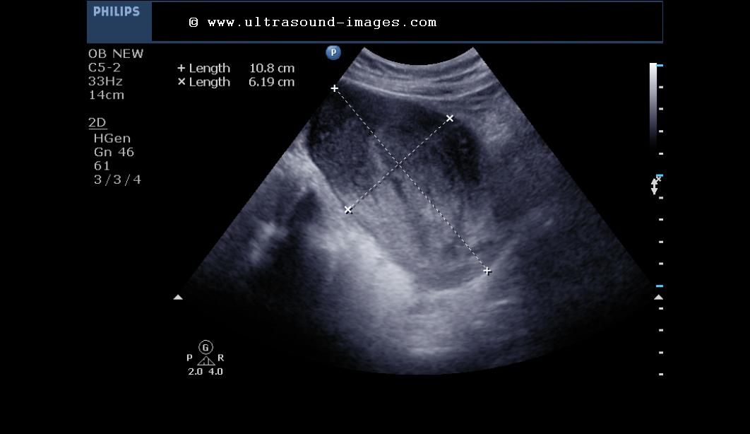 Products Of Conception Ultrasound