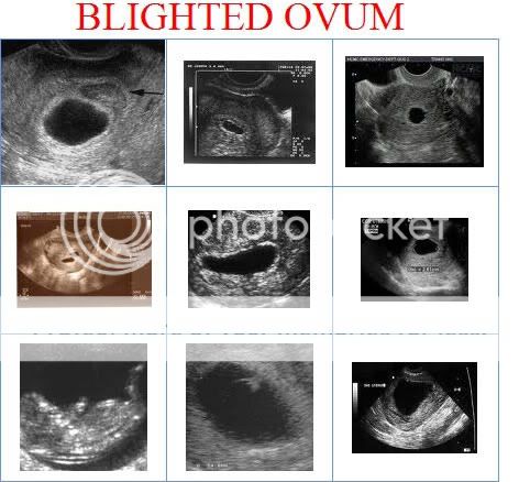 Products Of Conception Ultrasound