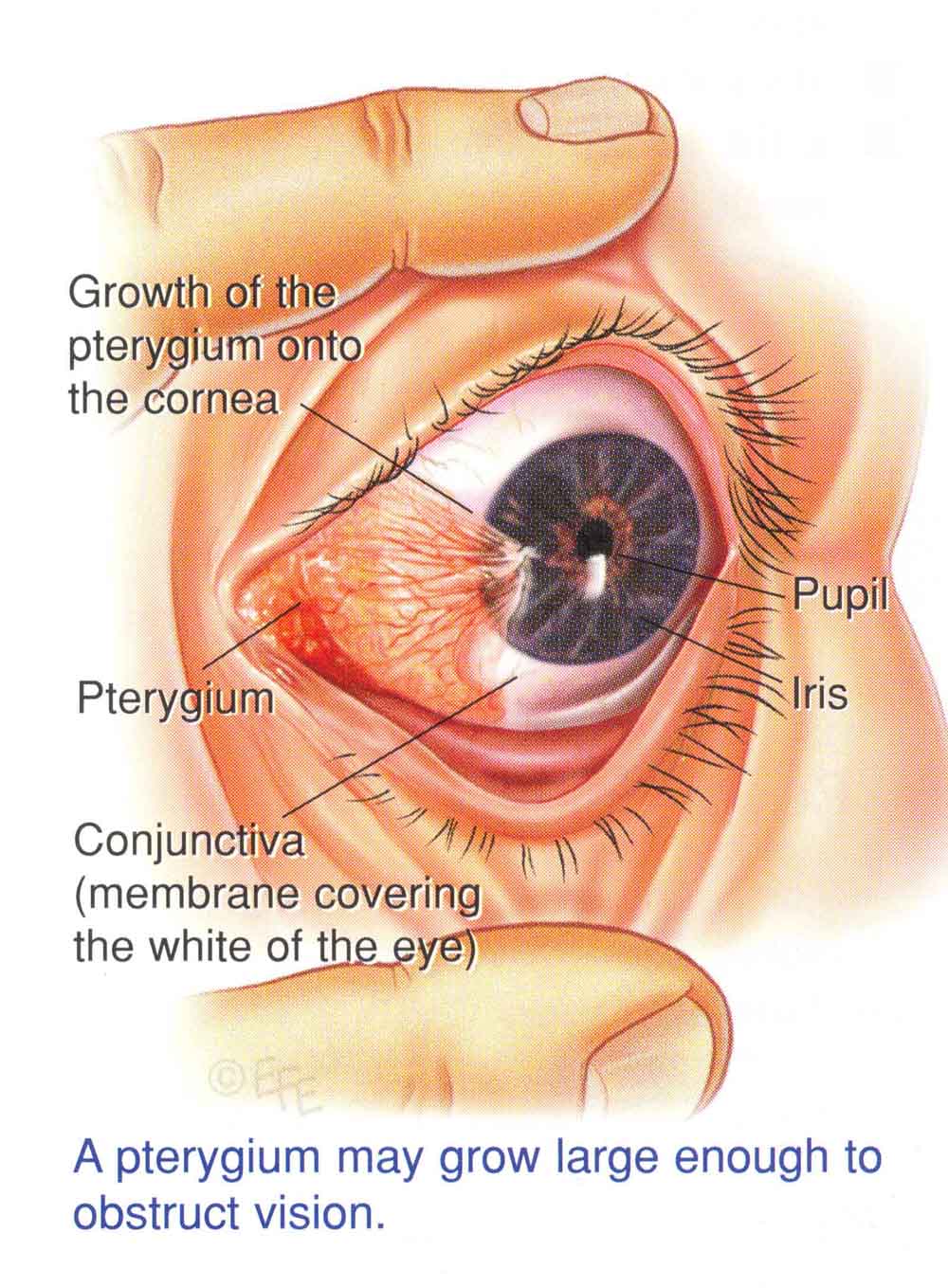 Pterygium