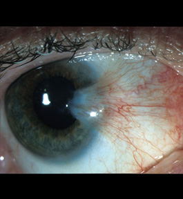 Pterygium