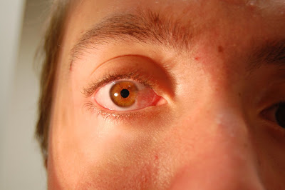 Pterygium