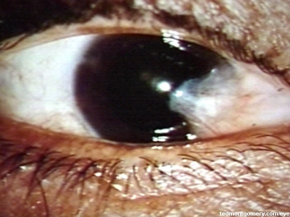 Pterygium