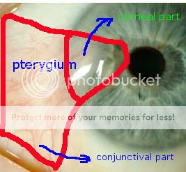 Pterygium Eye