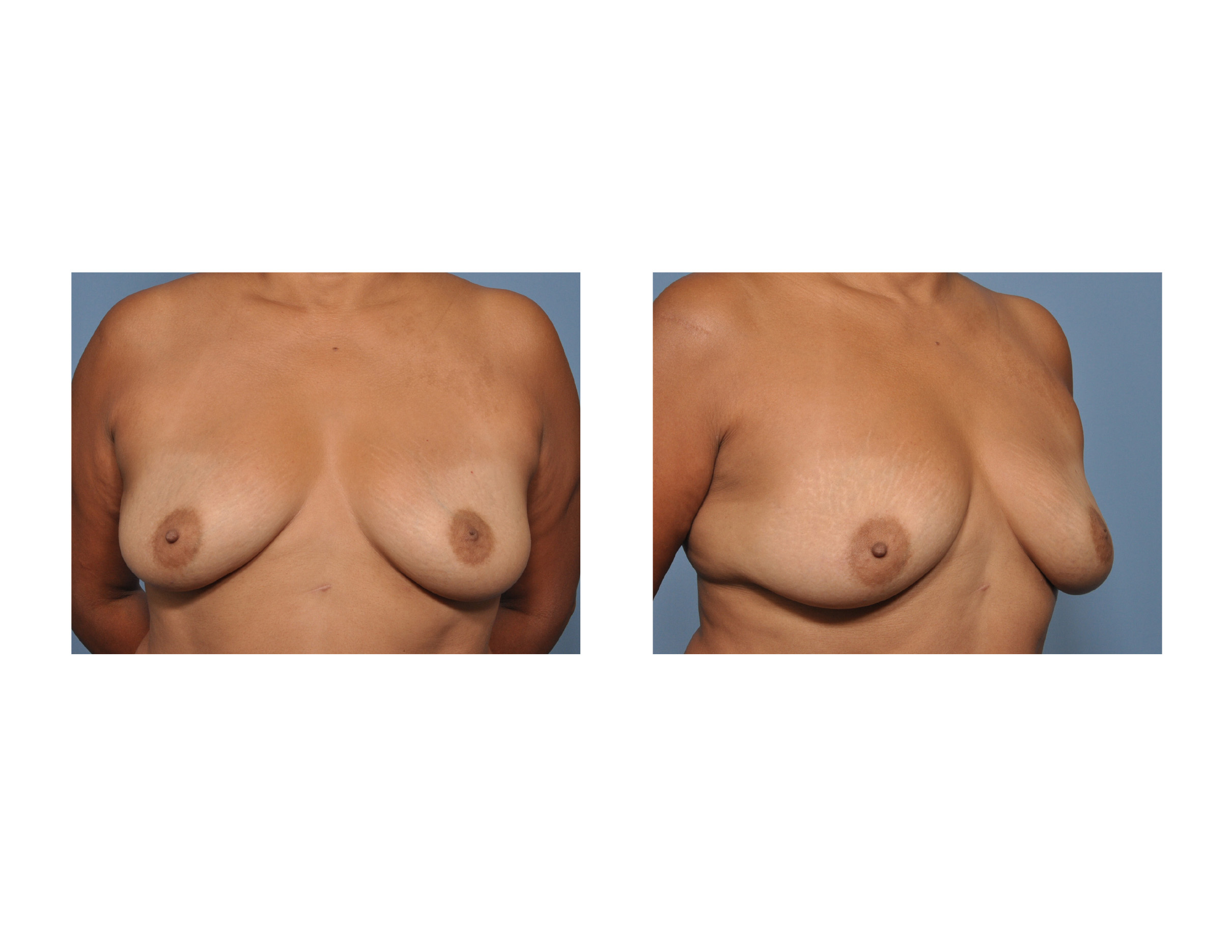 Ptosis Breast