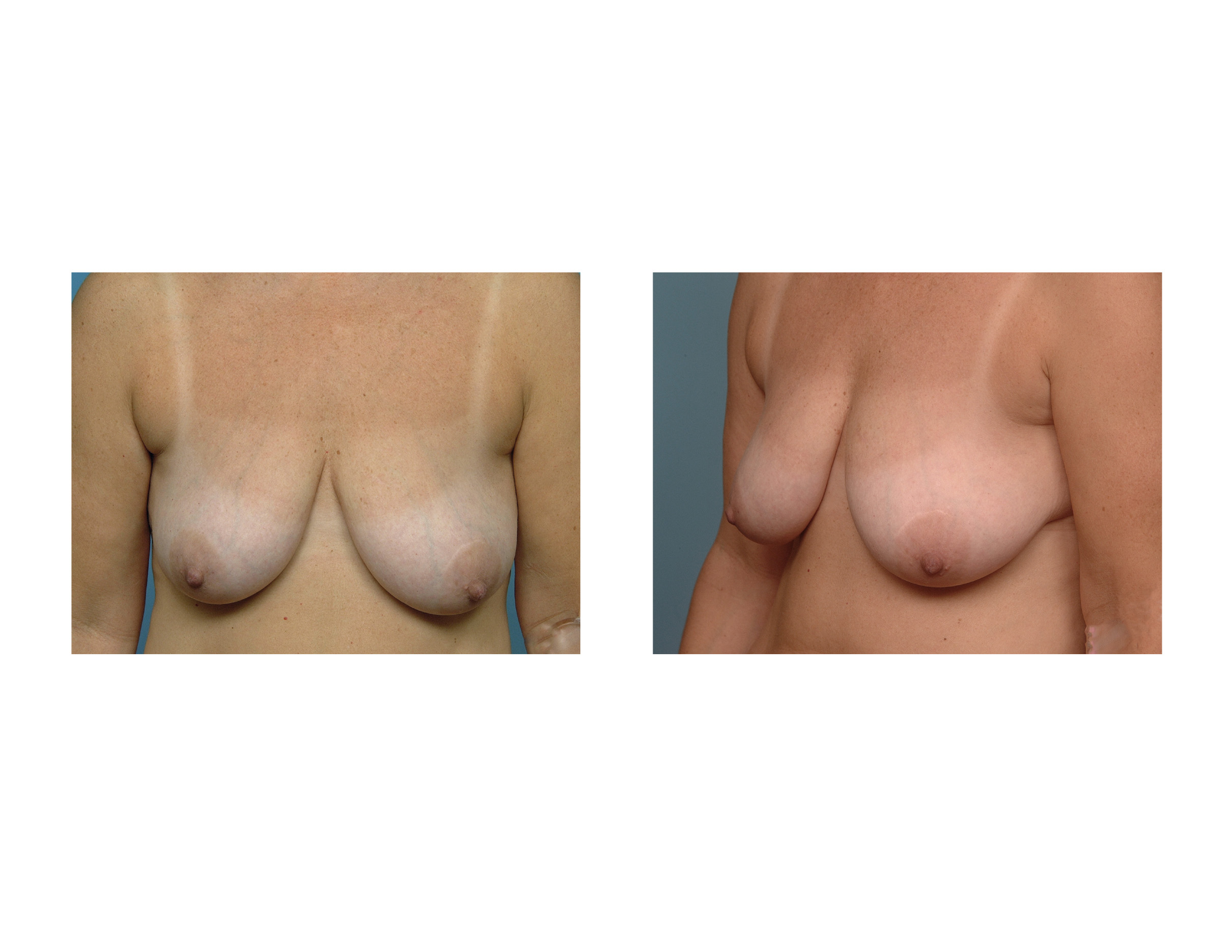 Ptosis Breast