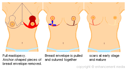 Ptosis Breast